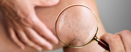 Escleroterapia y Calidad de Vida